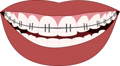 orthodontics 3109763_640 1 