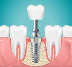 denteka les implants dentaires